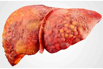 برای سلامت کبد این ویتامینها معجزه میکند برای سلامت کبد این ویتامینها معجزه میکند