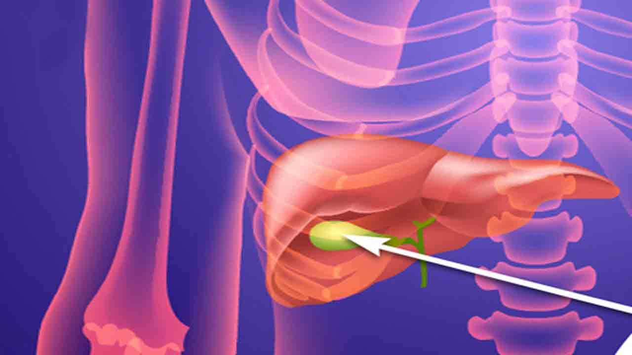 چگونه از بروز سنگ صفرا جلوگیری کنیم؟