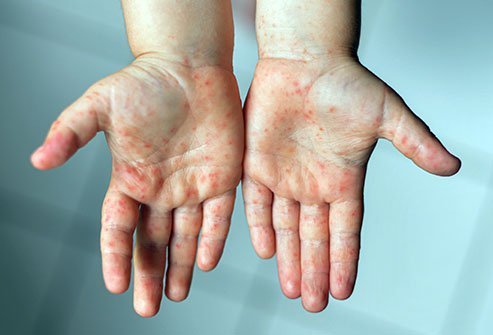 جزئیاتی درباره شیوع بیماری «دست و پا و دهان» / کودکان اصلی‌ترین میزبان ویروس