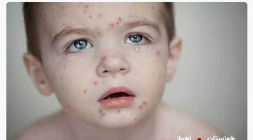 واکسینه کردن کودکان علیه بیماری سرخک