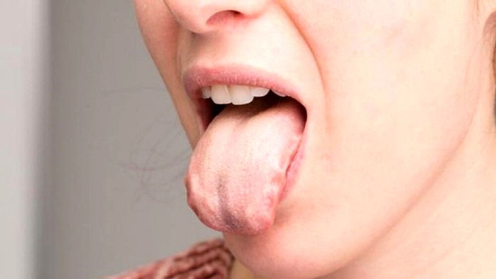 سوزش زبان نشانه این بیماری خطرناک است؛ جدی بگیرید