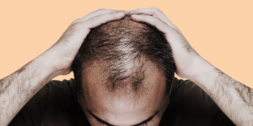 چگونه بدانیم ریزش موی سر ما غیرطبیعی است