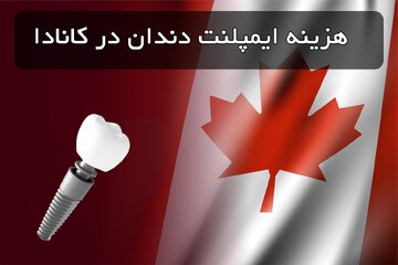 هزینه ایمپلنت دندان در کانادا چقدر است؟