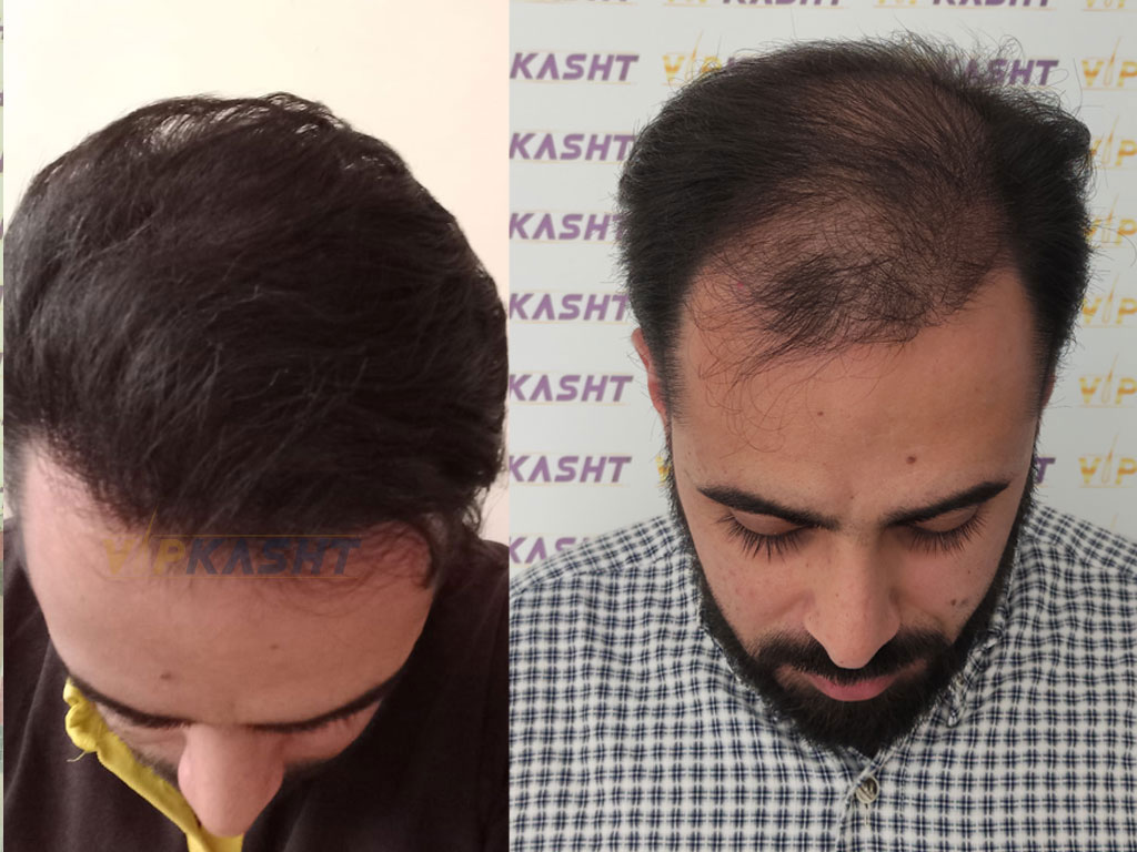 کدام یک برای من بهتر است، پی آر پی یا کاشت مو؟