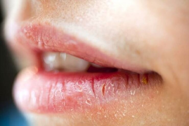 چرا لبها ترک میخورند؟/ راهکارهایی برای درمان و پیشگیری از خشکی لب