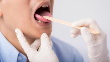 علائم شایع سرطان دهان علائم شایع سرطان دهان