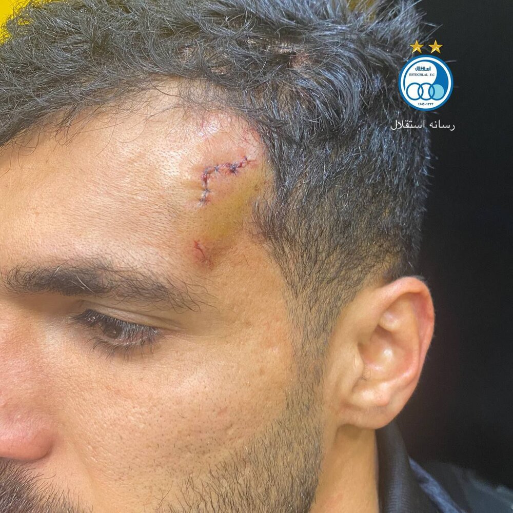 عکس | مصدومیت هافبک استقلال از ناحیه سر