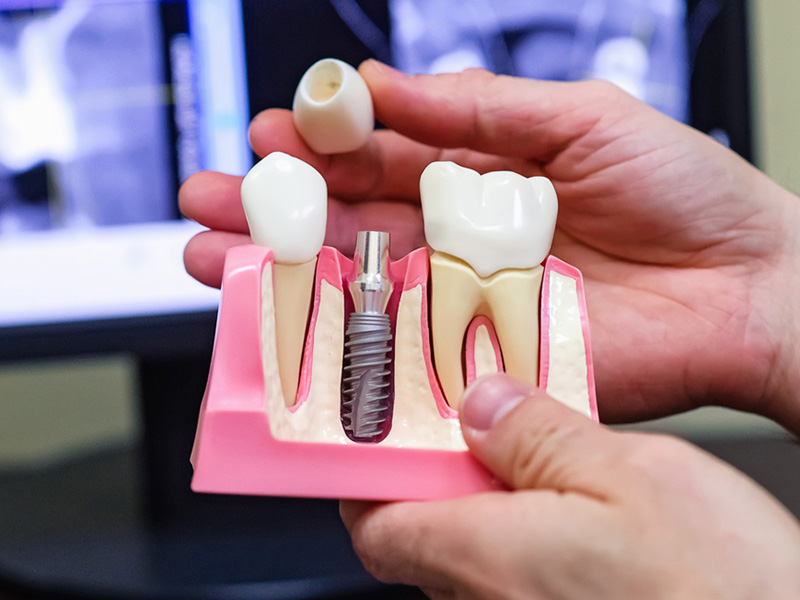 همه چیز درباره ی ایمپلنت دندان