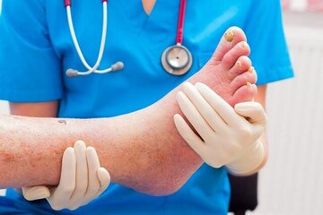 چگونه از عارضه «پای دیابتی» پیشگیری کنیم؟/ این توصیه‌ها را جدی بگیرید