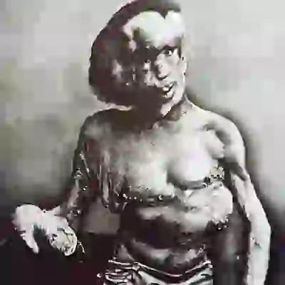 عکس | راز « مرد فیلی» که گمان میشد، طاعون خیارکی دارد!