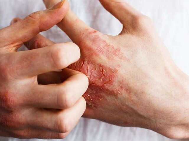 همه چیز درباره انواع «حساسیت‌های پوستی» و نشانه‌های آن/ دلیل خارش بدن چیست؟