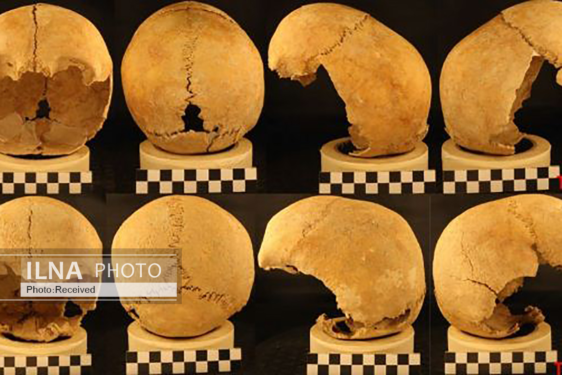 شواهد کوبیدن میخ در جمجمه برای جلوگیری از سرایت بیماری صرع به دیگران