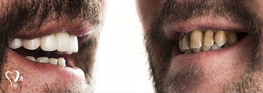 توصیه های مهم برای مراقبت از دندان ها