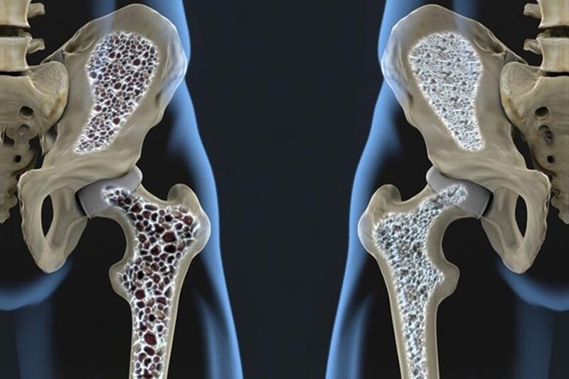 - ۳ خطر بزرگ پوکی استخوان که کمتر کسی می‌داند