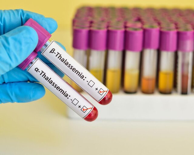 نکاتی درباره «تالاسمی»/ علائم این بیماری چیست؟