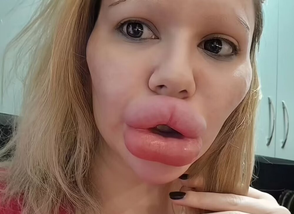 عکس| وحشت نکنید! این زن با تزریق ژل به لبهایش میخواهد رکورد گینس را بزند