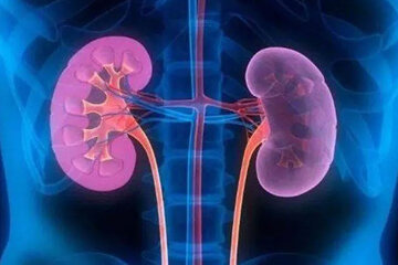 چگونه میتوان از ابتلا به سنگ کلیه پیشگیری کرد؟