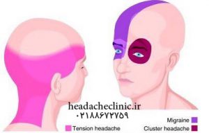 درمان سردرد میگرنی در کلینیک سردرد تهران
