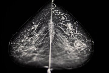 دقت حیرت‌انگیز هوش مصنوعی در تشخیص سرطان سینه/ عکس 