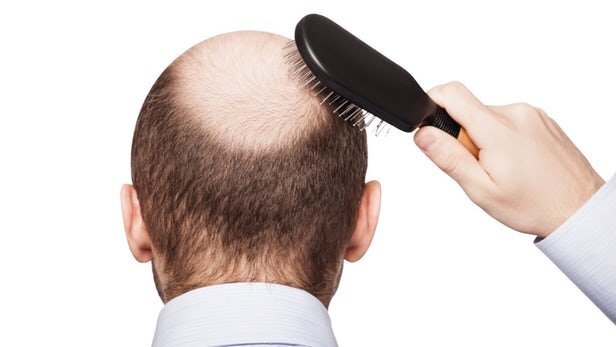اگر ریزش مو دارید این مطلب را بخوانید/ مواد غذایی مفید برای کاهش ریزش مو
