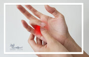 آیا شکست قولنج انگشتان باعث آرتروز می‌شود؟