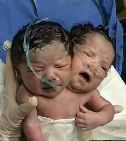 تولد عجیب یک نوزاد در مکزیک با دو سر/ عکس