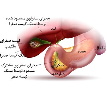 سنگ کیسه صفرا در بارداری و تأثیر آن بر سلامتی جنین