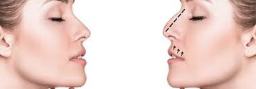 Is getting a Nose Job Dangerous?