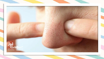 چگونه از شر جوشهای سر سیاه خلاص شویم؟ چگونه از شر جوشهای سر سیاه خلاص شویم؟