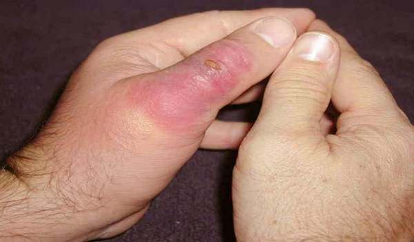 نیش مار و عقرب سال گذشته چند ایرانی را راهی بیمارستان کرد؟/ رتبه جالب عقرب گزیدگی ایران در جهان