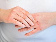 علائم اگزمای پوستی/ تغذیه بر درمان اگزما اثر دارد؟