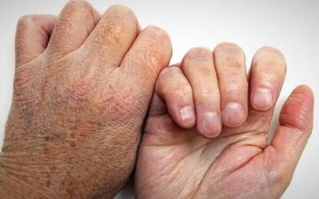 شیوع بیماری جذام در کشور صحت دارد؟ شیوع بیماری جذام در کشور صحت دارد؟