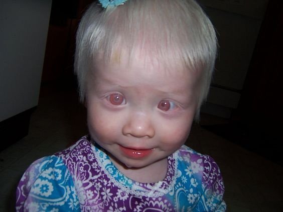 عکس | رنگ چشم این افراد قرمز است!