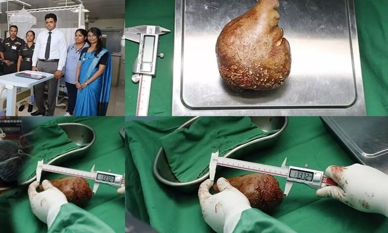 خارج کردن سنگ کلیه ۱۳ سانتیمتری از کلیه یک بیمار/ عکس