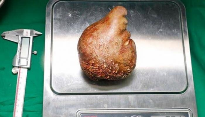 خارج کردن سنگ کلیه ۱۳ سانتیمتری از کلیه یک بیمار/ عکس