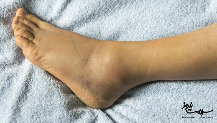 ۱۲ علامت هشدار دهنده بیماری قلبی که روی پوست ظاهر میشود