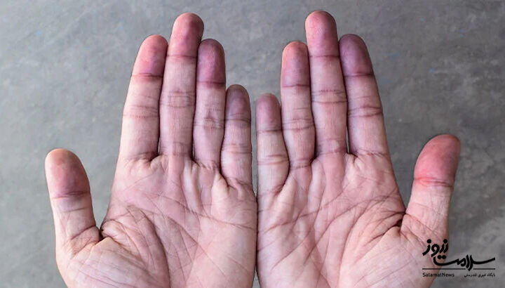 ۱۲ علامت هشدار دهنده بیماری قلبی که روی پوست ظاهر میشود