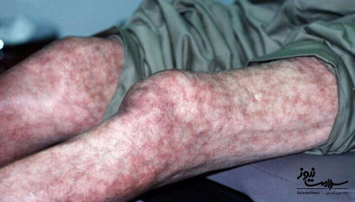 ۱۲ علامت هشدار دهنده بیماری قلبی که روی پوست ظاهر میشود