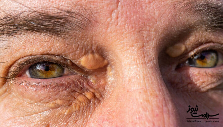 ۱۲ علامت هشدار دهنده بیماری قلبی که روی پوست ظاهر میشود