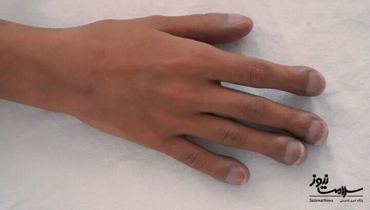 ۱۲ علامت هشدار دهنده بیماری قلبی که روی پوست ظاهر میشود