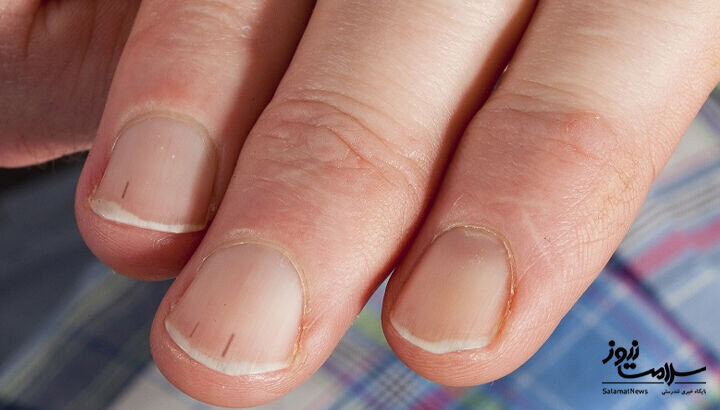 ۱۲ علامت هشدار دهنده بیماری قلبی که روی پوست ظاهر میشود