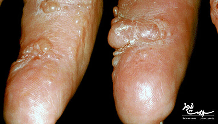 ۱۲ علامت هشدار دهنده بیماری قلبی که روی پوست ظاهر میشود