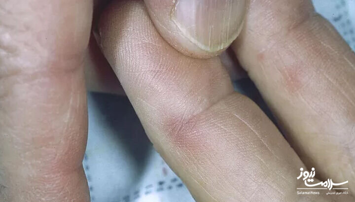 ۱۲ علامت هشدار دهنده بیماری قلبی که روی پوست ظاهر میشود