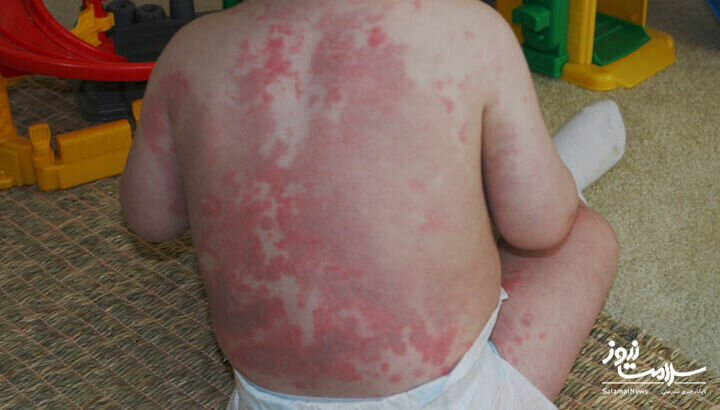 ۱۲ علامت هشدار دهنده بیماری قلبی که روی پوست ظاهر میشود