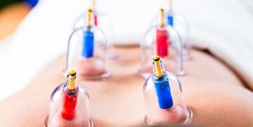 حجامت در چه صورت مفید است؟ حجامت در چه صورت مفید است؟