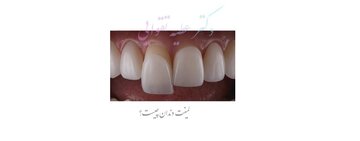 ناگفته‌هایی درباره‌ی لمینت دندان و کامپوزیت دندان؛ روش‌های اصلاح طرح لبخند