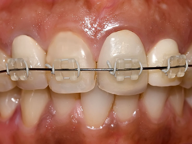 همه چیز درباره ارتودنسی دندان بزرگسالان