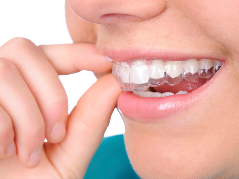 همه چیز درباره ارتودنسی دندان بزرگسالان