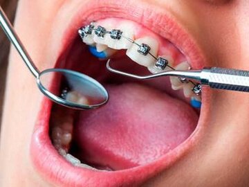 همه چیز درباره ارتودنسی دندان بزرگسالان
