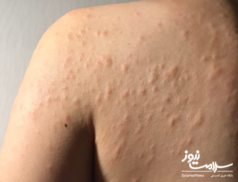 علائم هشدار دهنده «بیماری کلیوی» که روی پوست ظاهر می‌شوند/ این نشانه‌ها را جدی بگیرید